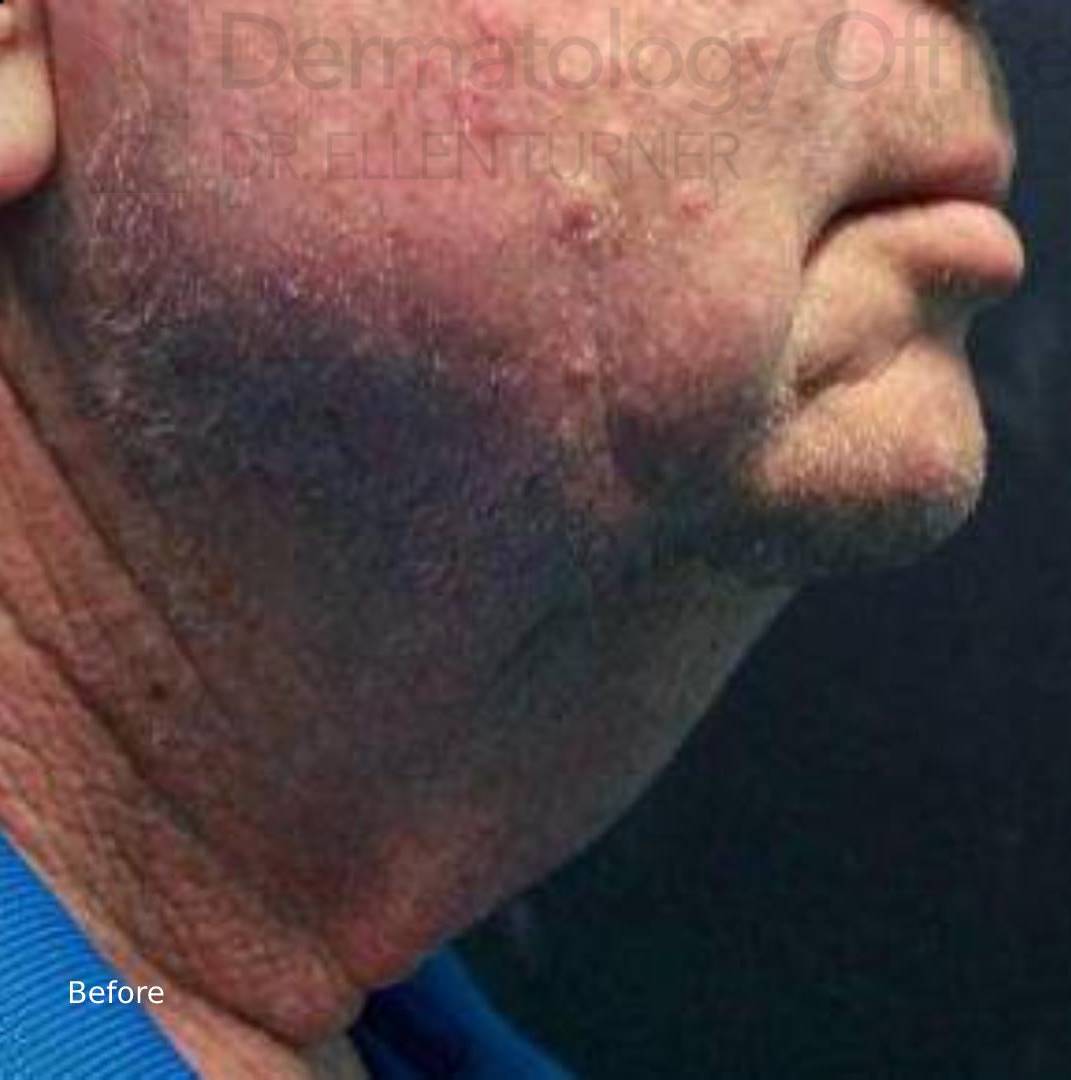Kybella (2 Series) Before and After Case 3 Before