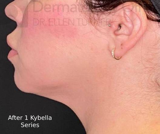 Kybella (1 Series) Before and After Case 4 After