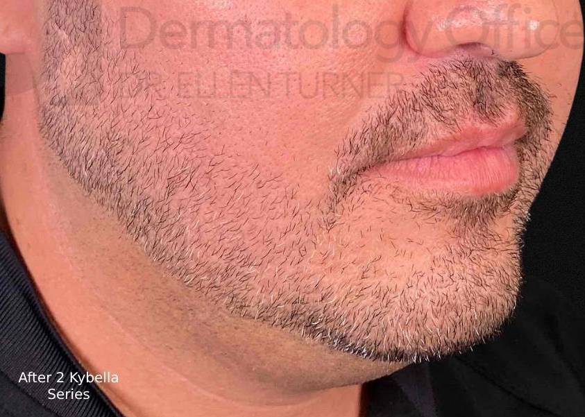 Kybella (2 Series) Case-6 After