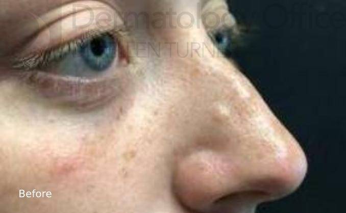 Injectable Rhinoplasty Before and After Case 2 Before