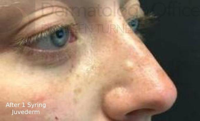 Injectable Rhinoplasty Before and After Case 2 After