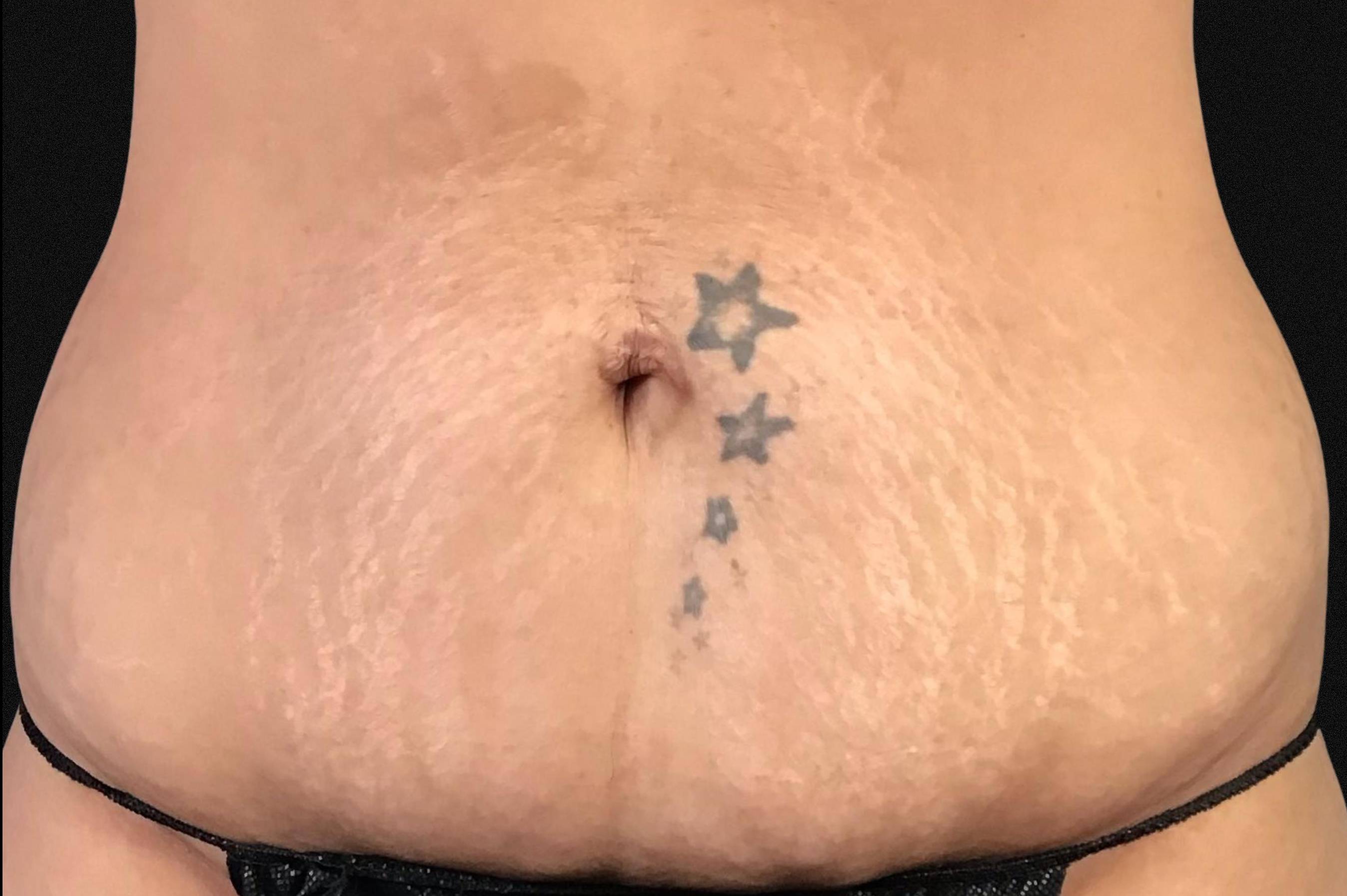 Microneedling Before and After Before