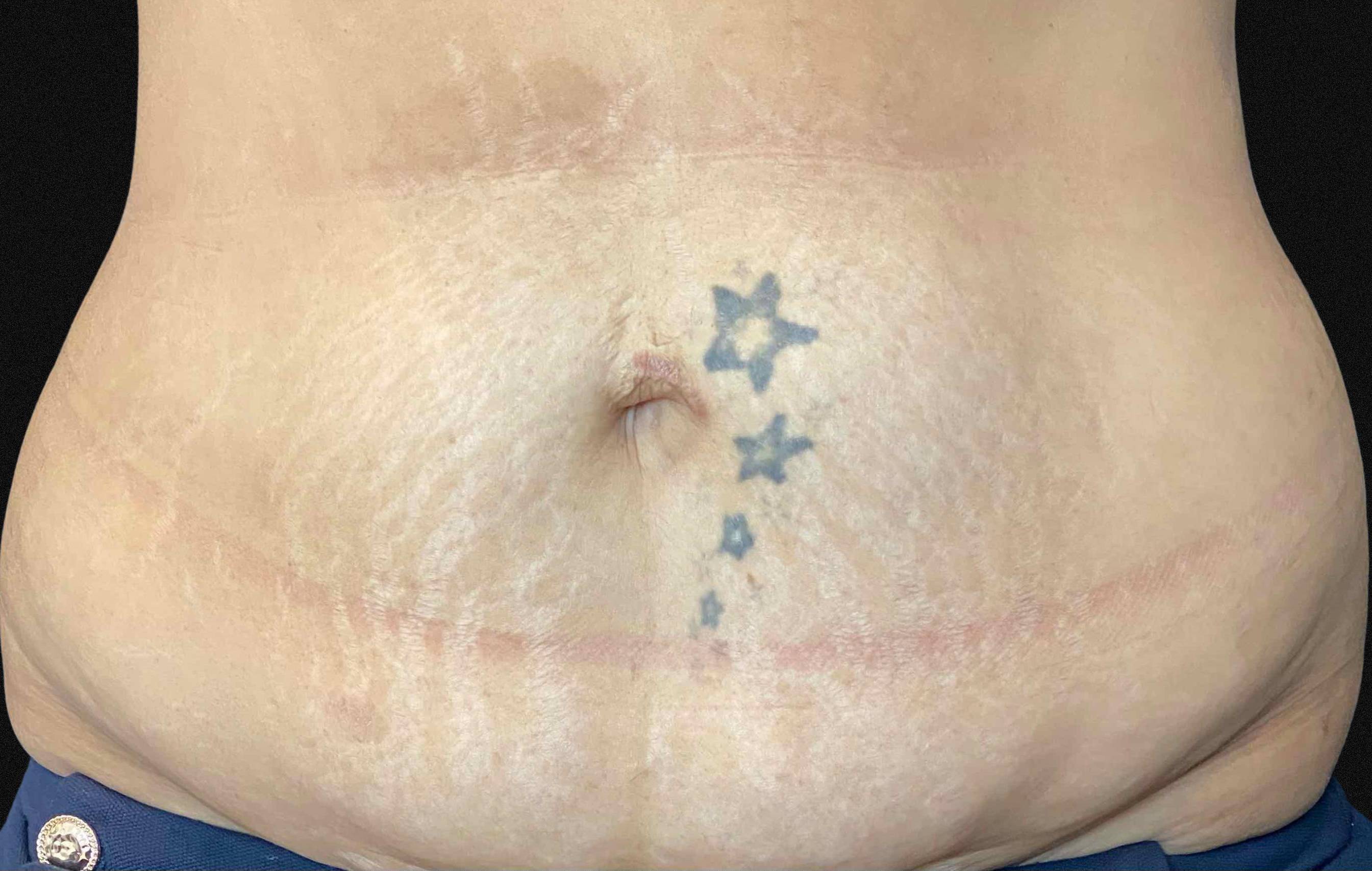 Microneedling Before and After After
