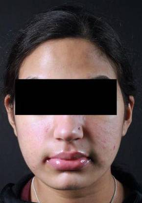 Acne Before and After Case 8 After