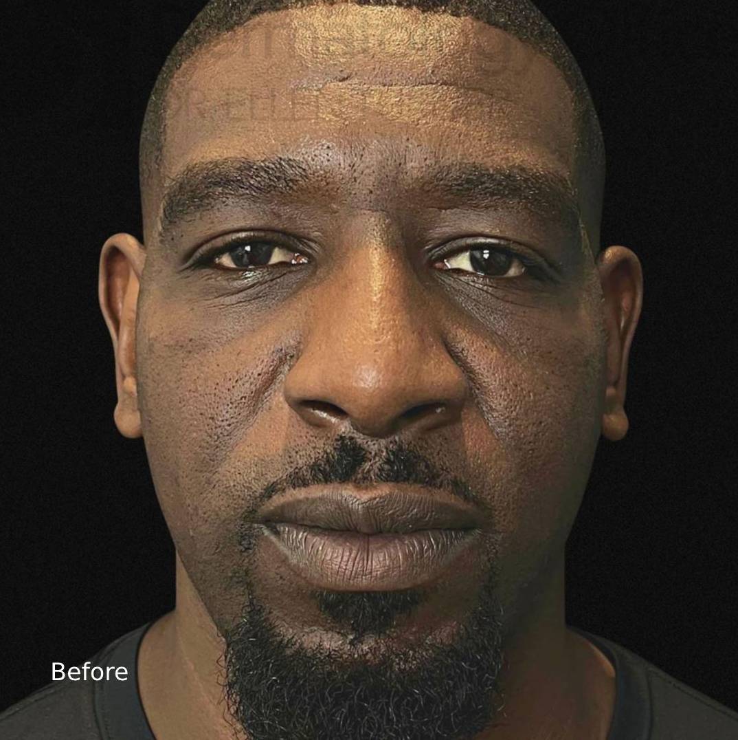 EMFACE (4 treatments)  Before and After Case-6 Before
