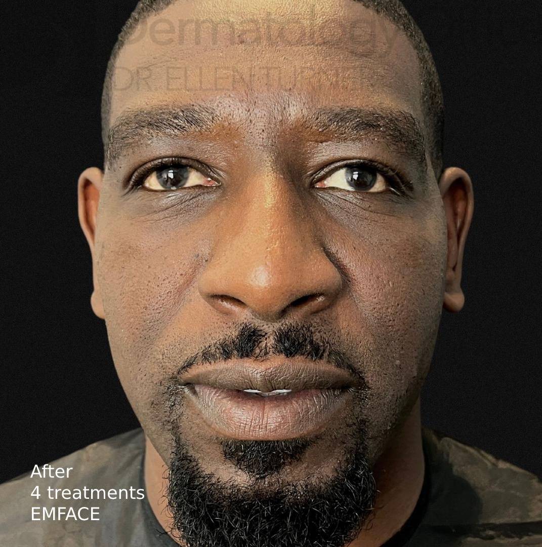 EMFACE (4 treatments)  Before and After Case-6 After