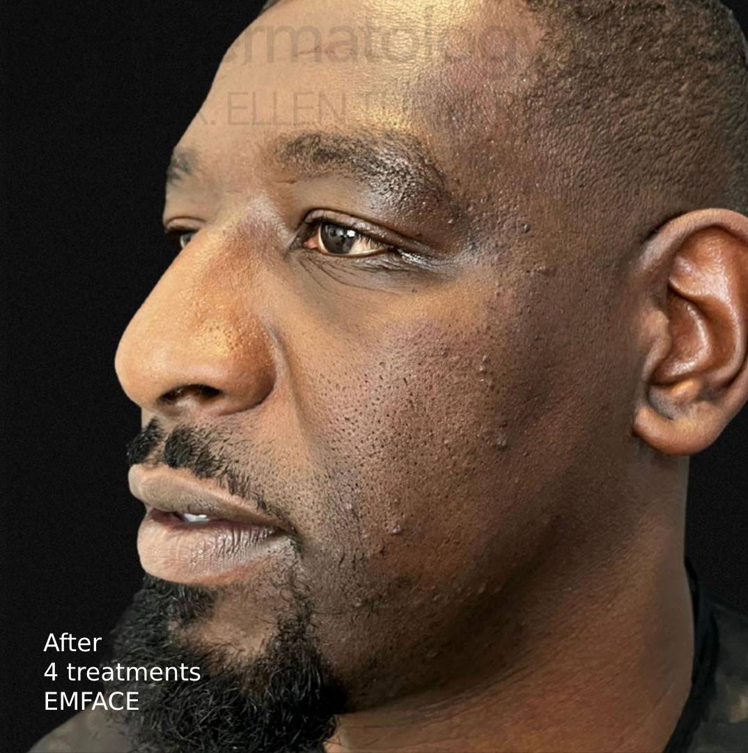EMFACE (4 treatments) Before and After Case-7 After