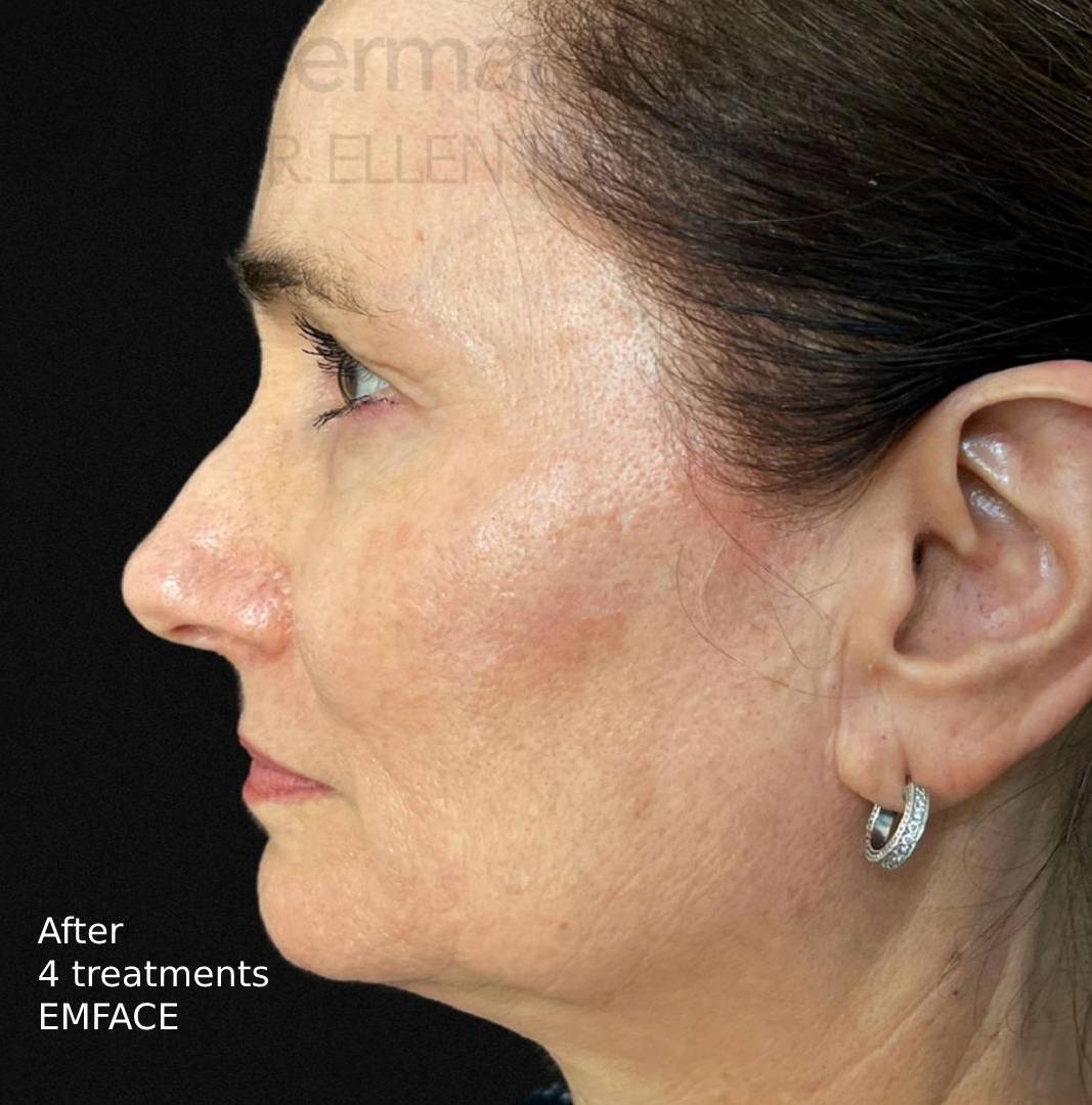 EMFACE (4 treatment) Before and After Case-9 After