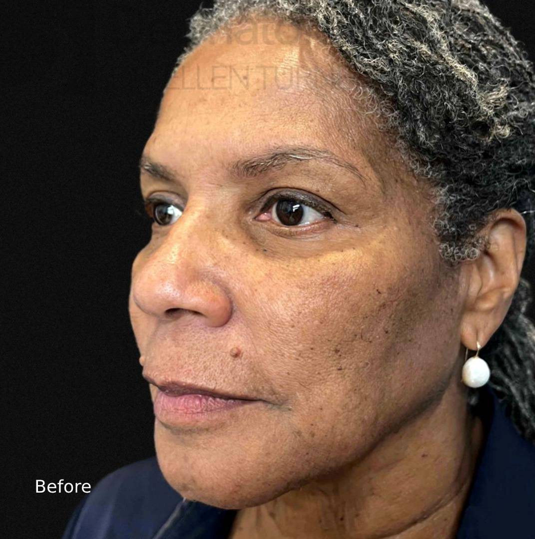 EMFACE (4 treatments) Before and After Case-14 Before