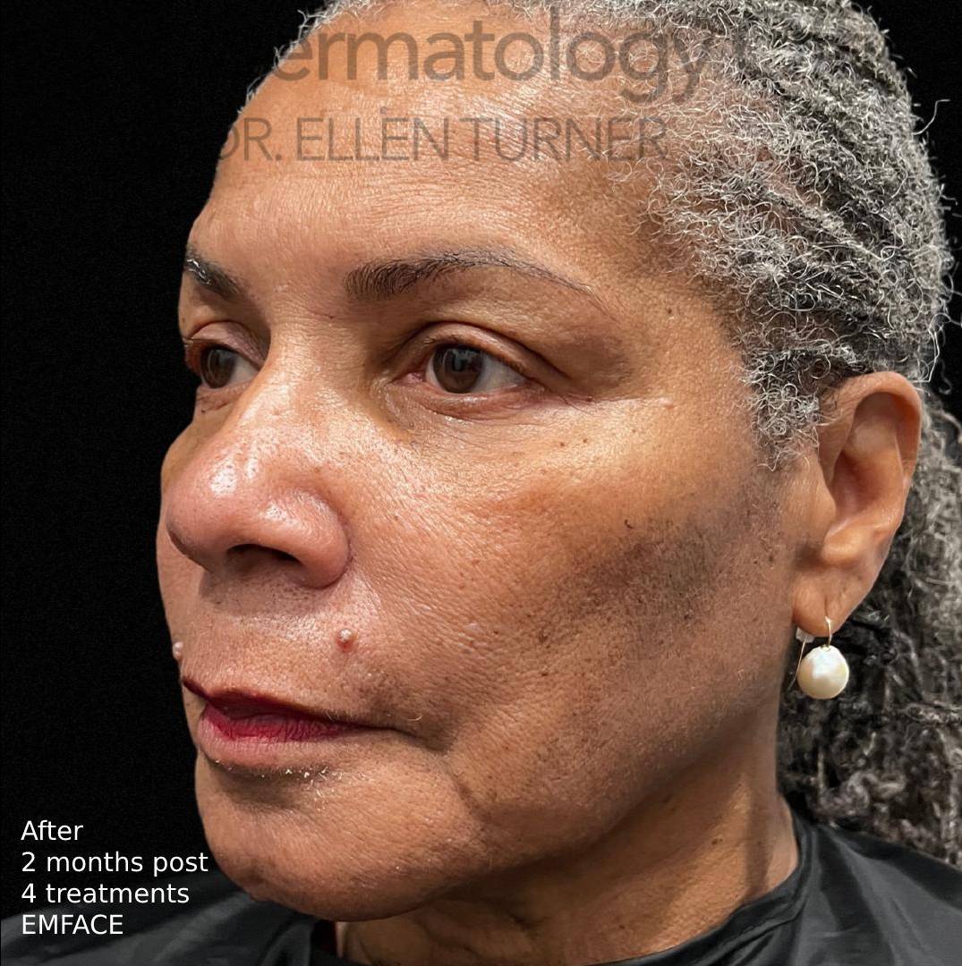 EMFACE (4 treatments) Before and After Case-14 After