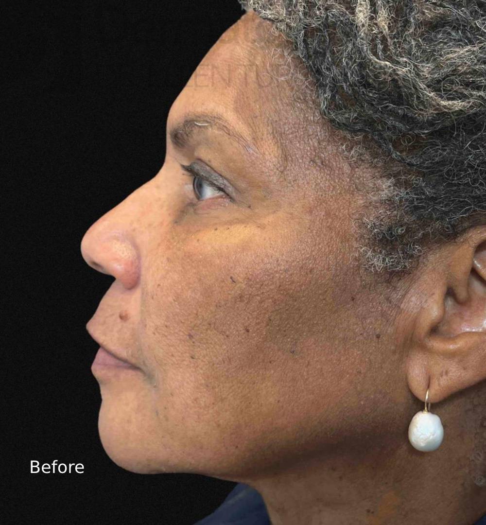 EMFACE (4 treatments) Before and After Case-15 Before