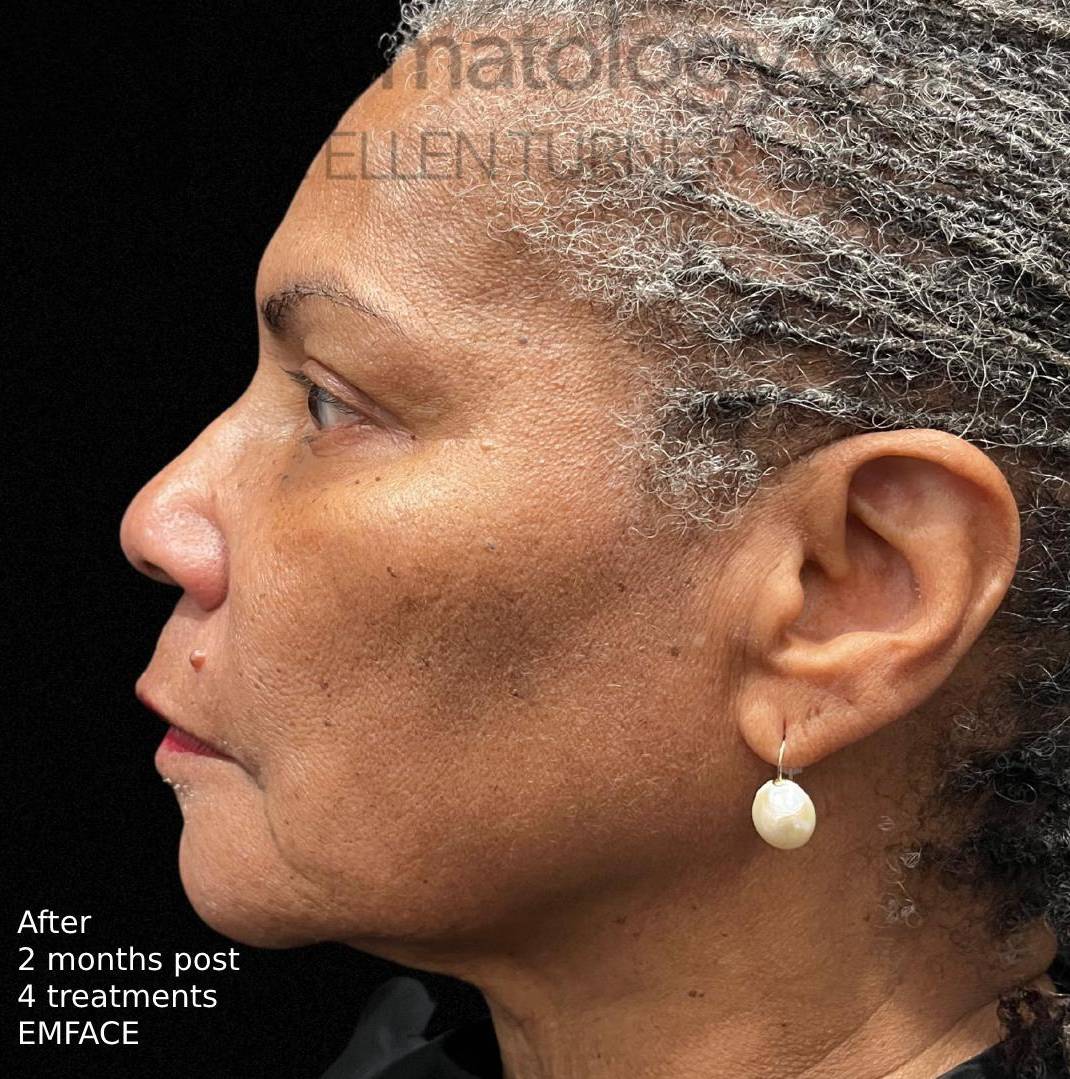 EMFACE (4 treatments) Before and After Case-15 After