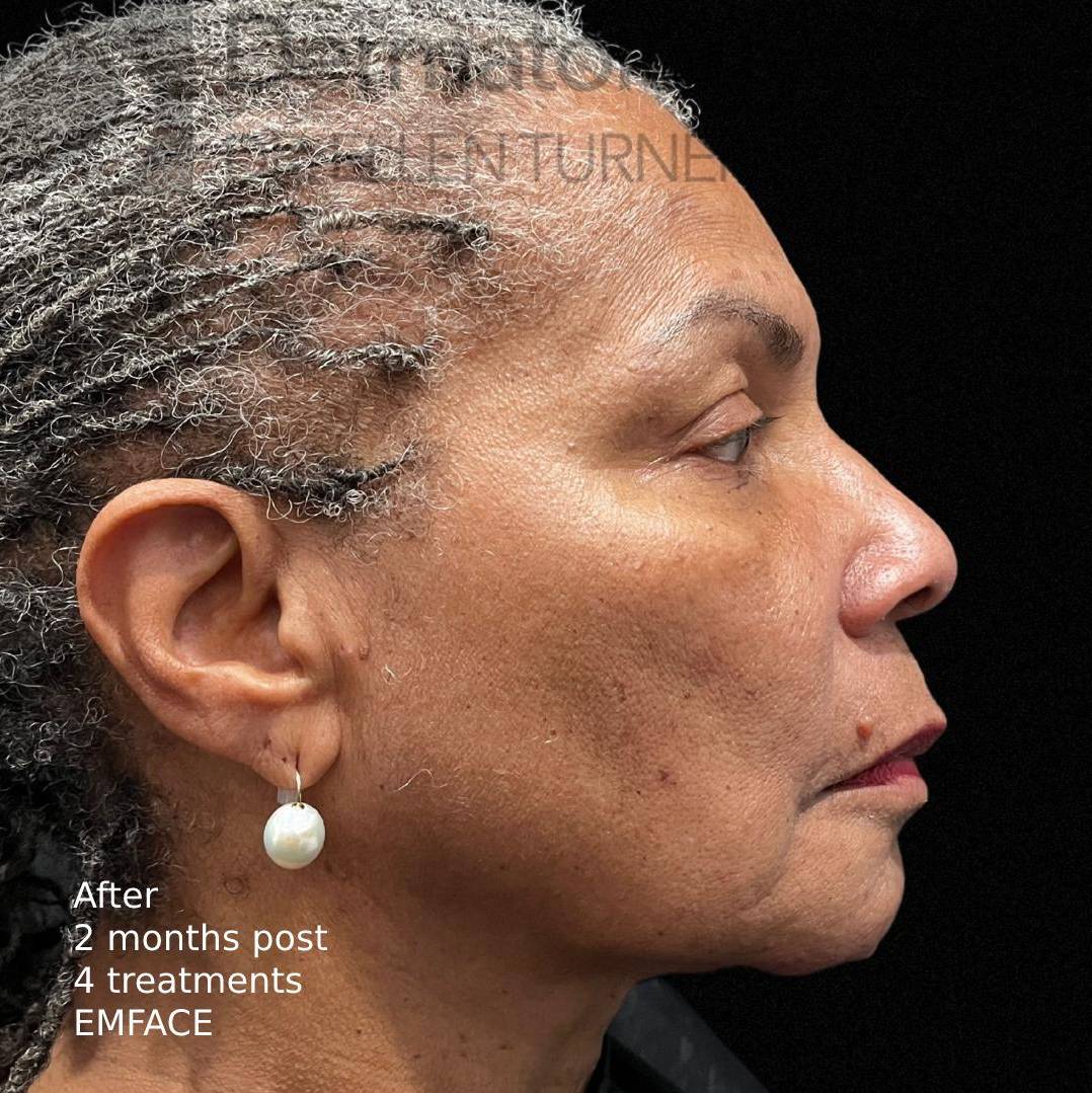 EMFACE (4 treatments) Before and After Case-17 After