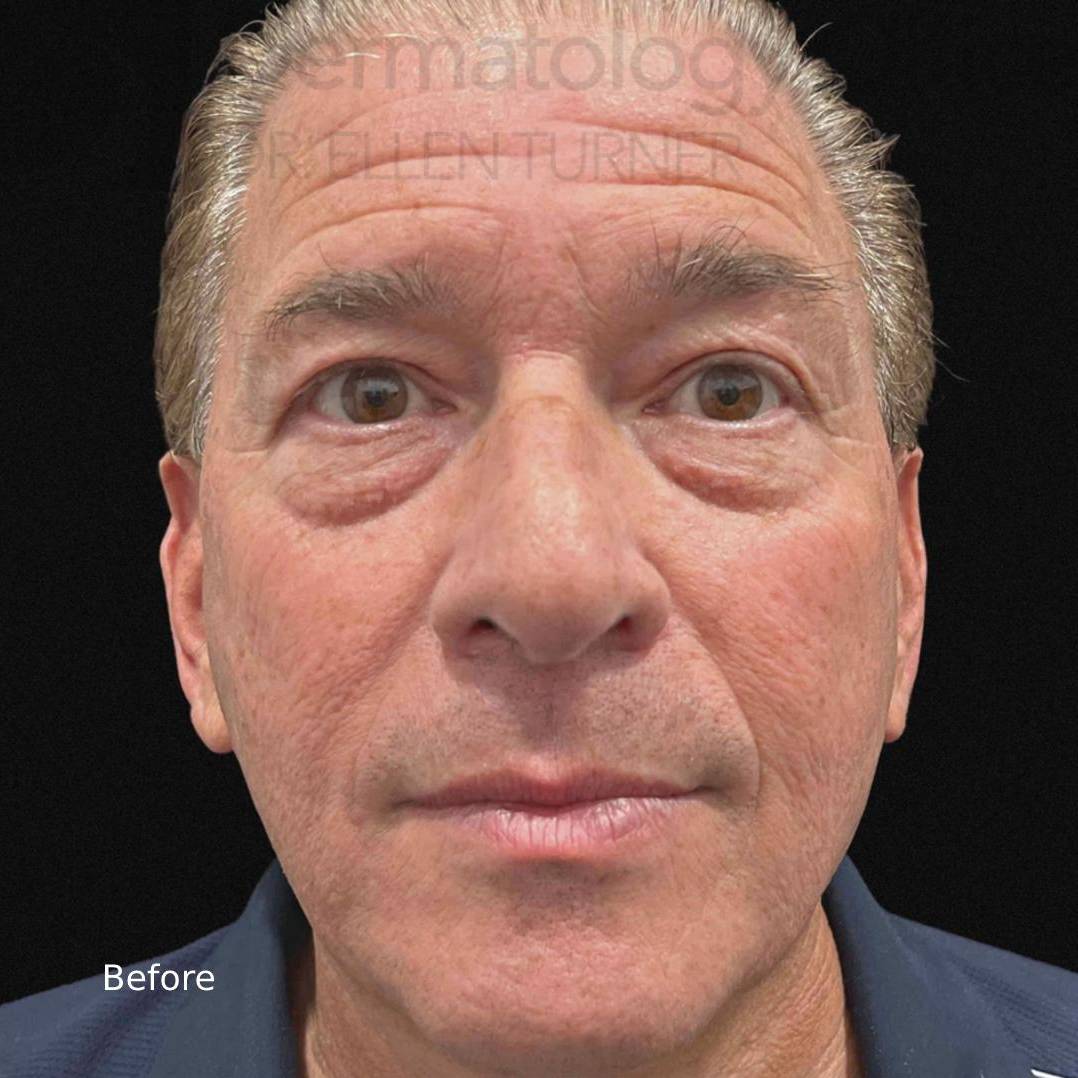 EMFACE (4 treatment) Before and After Case-20 Before