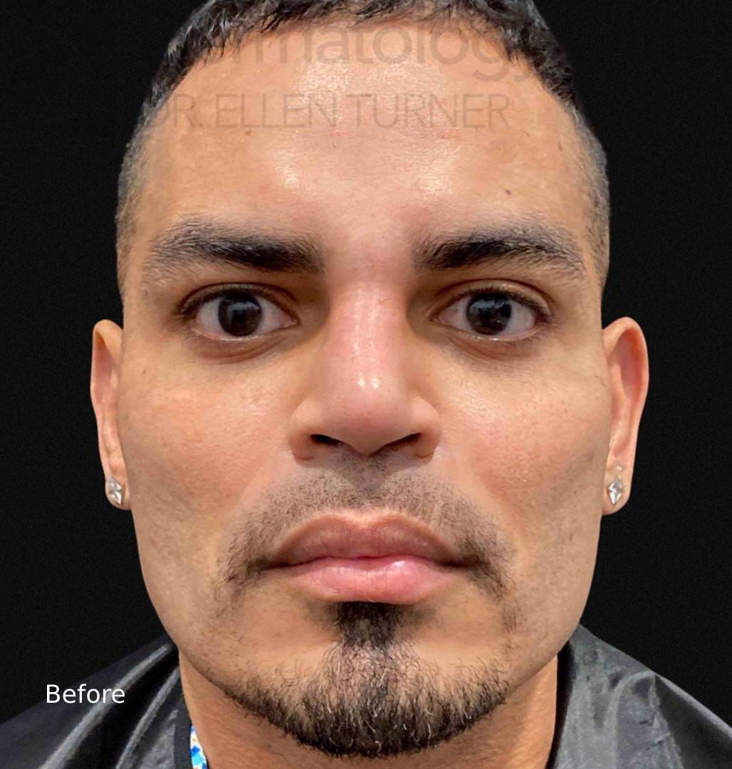 EMFACE (2 treatments) Before and After Case-21 Before