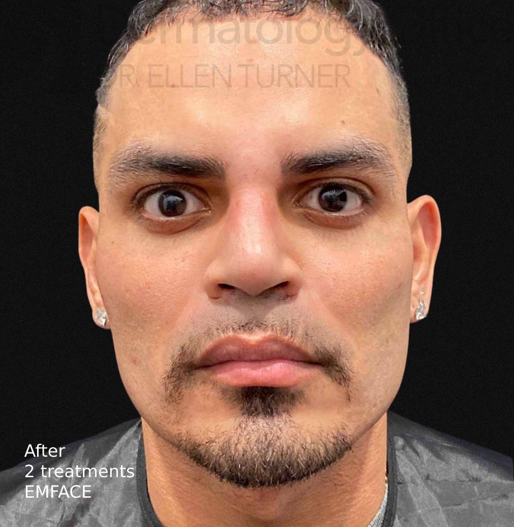 EMFACE (2 treatments) Before and After Case-21 After