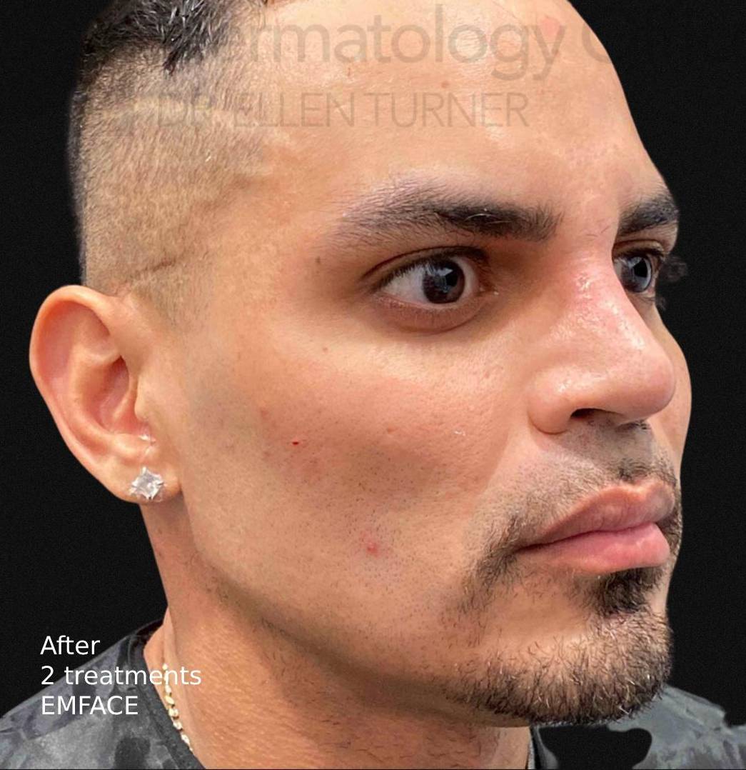 EMFACE (4 treatments) Before and After Case-22 After