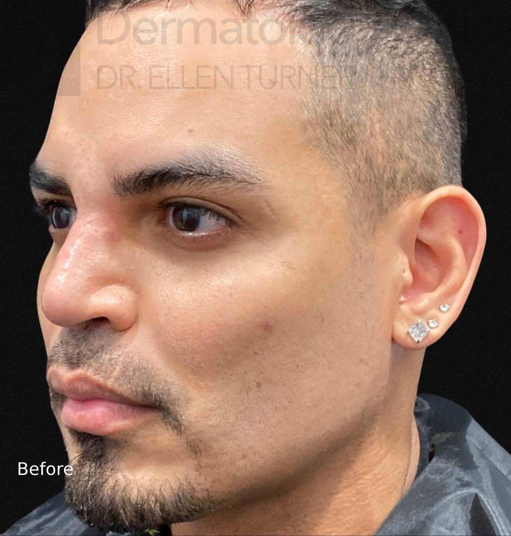 EMFACE (2 treatment) Before and After Case-23 Before