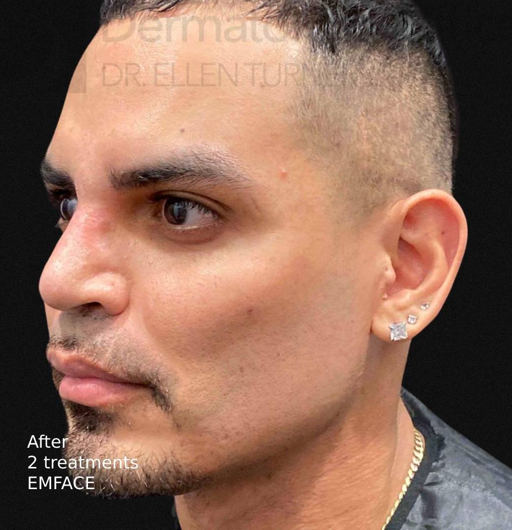EMFACE (2 treatment) Before and After Case-23 After