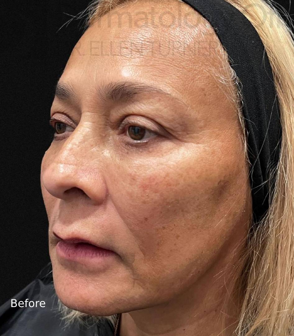 EMFACE (1 treatment) Before and After Case-25 Before
