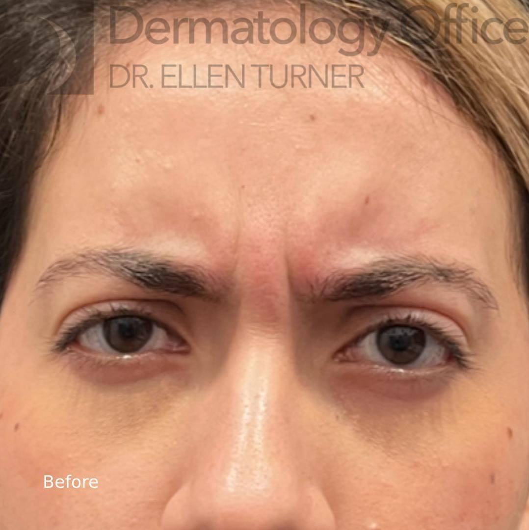 Botox (25 Units) Case-19 Before