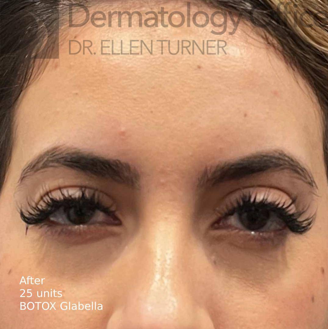 Botox (25 Units) Case-19 After