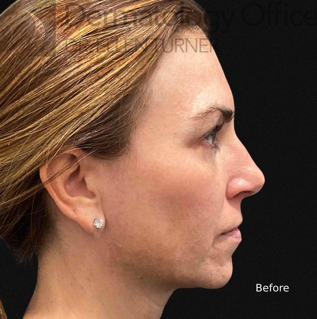 EMFACE (4 treatments) Before and After Case-28 Before