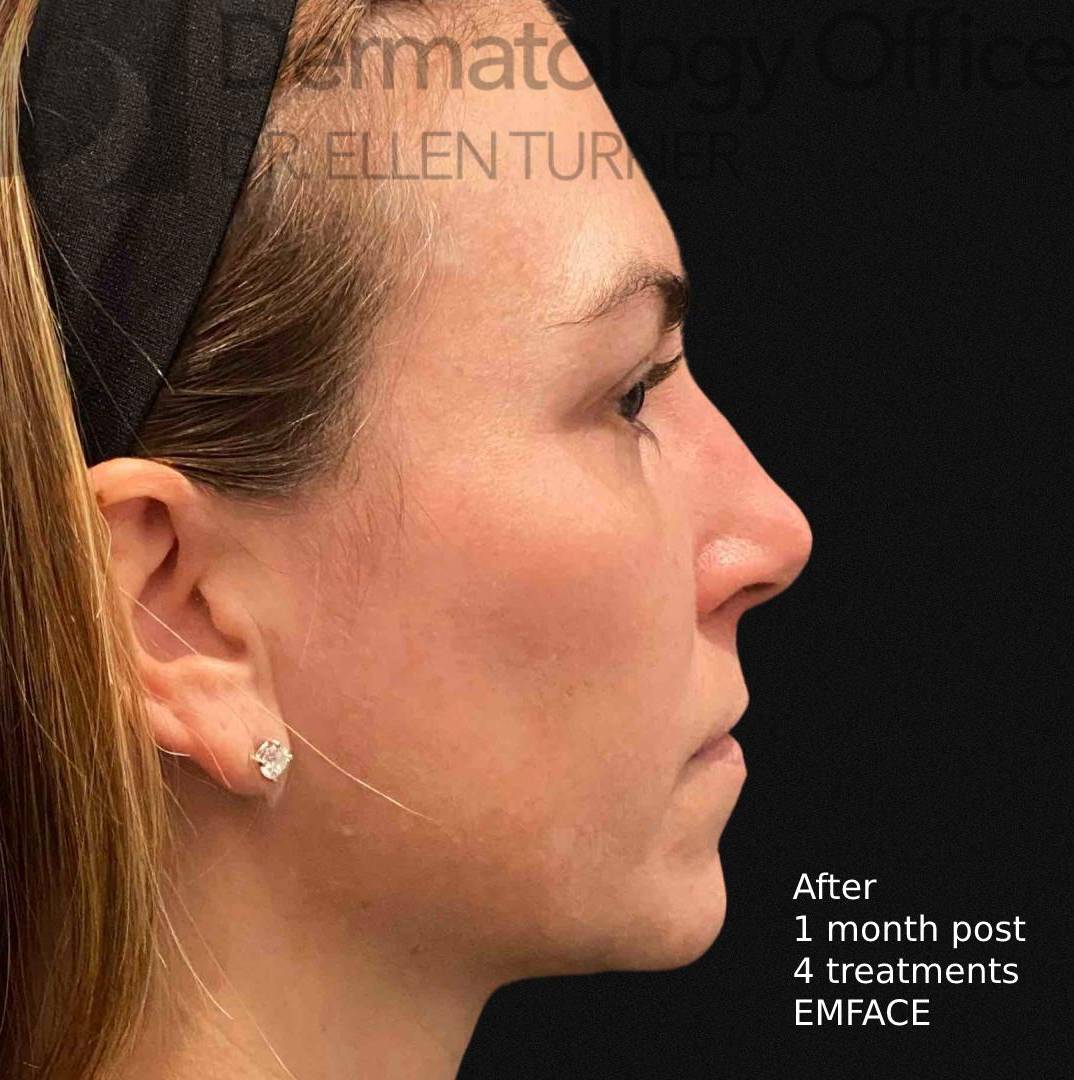 EMFACE (4 treatments) Before and After Case-28 After