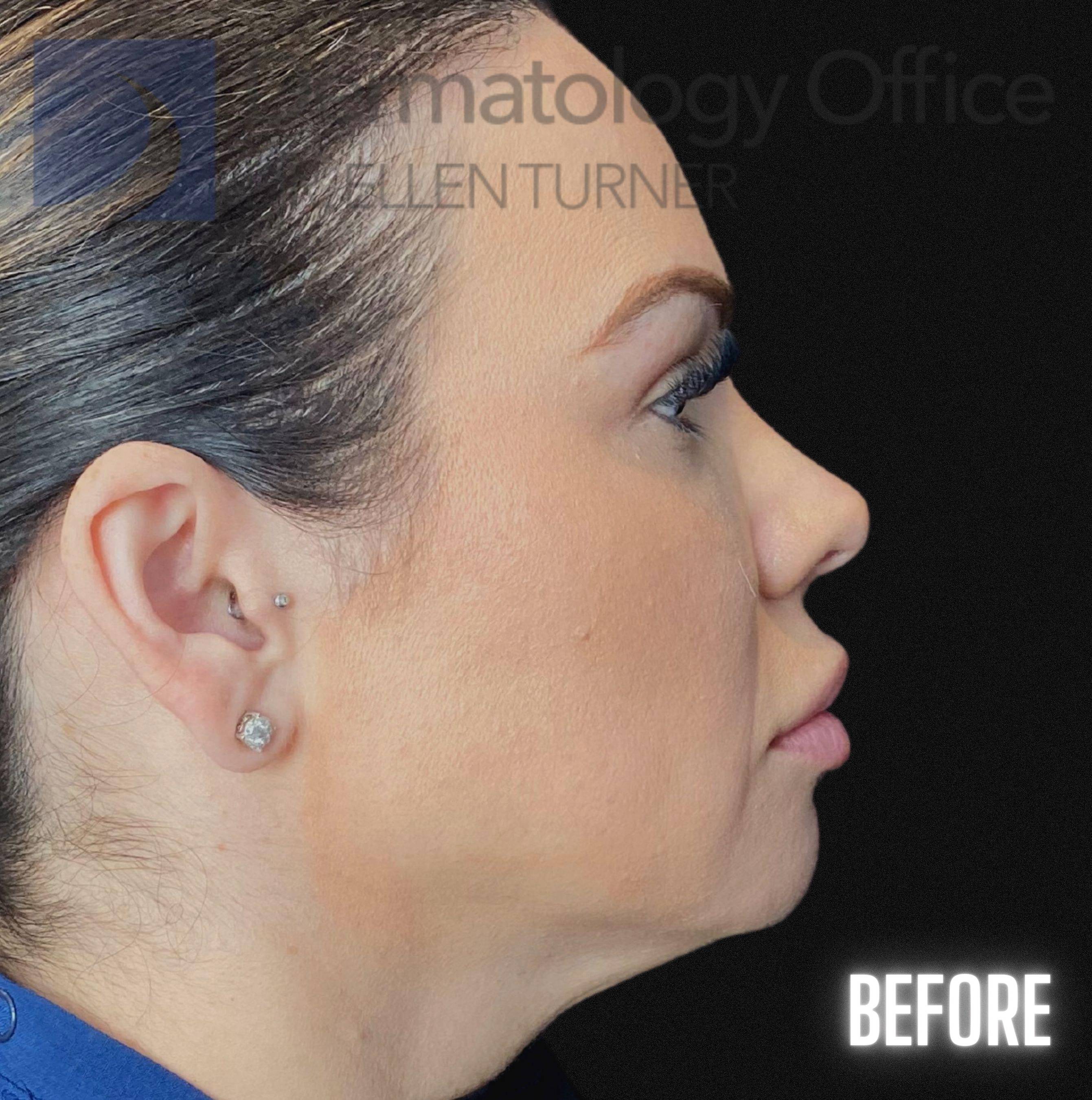 Volux (4 syringes) Before and After Case -1 Before