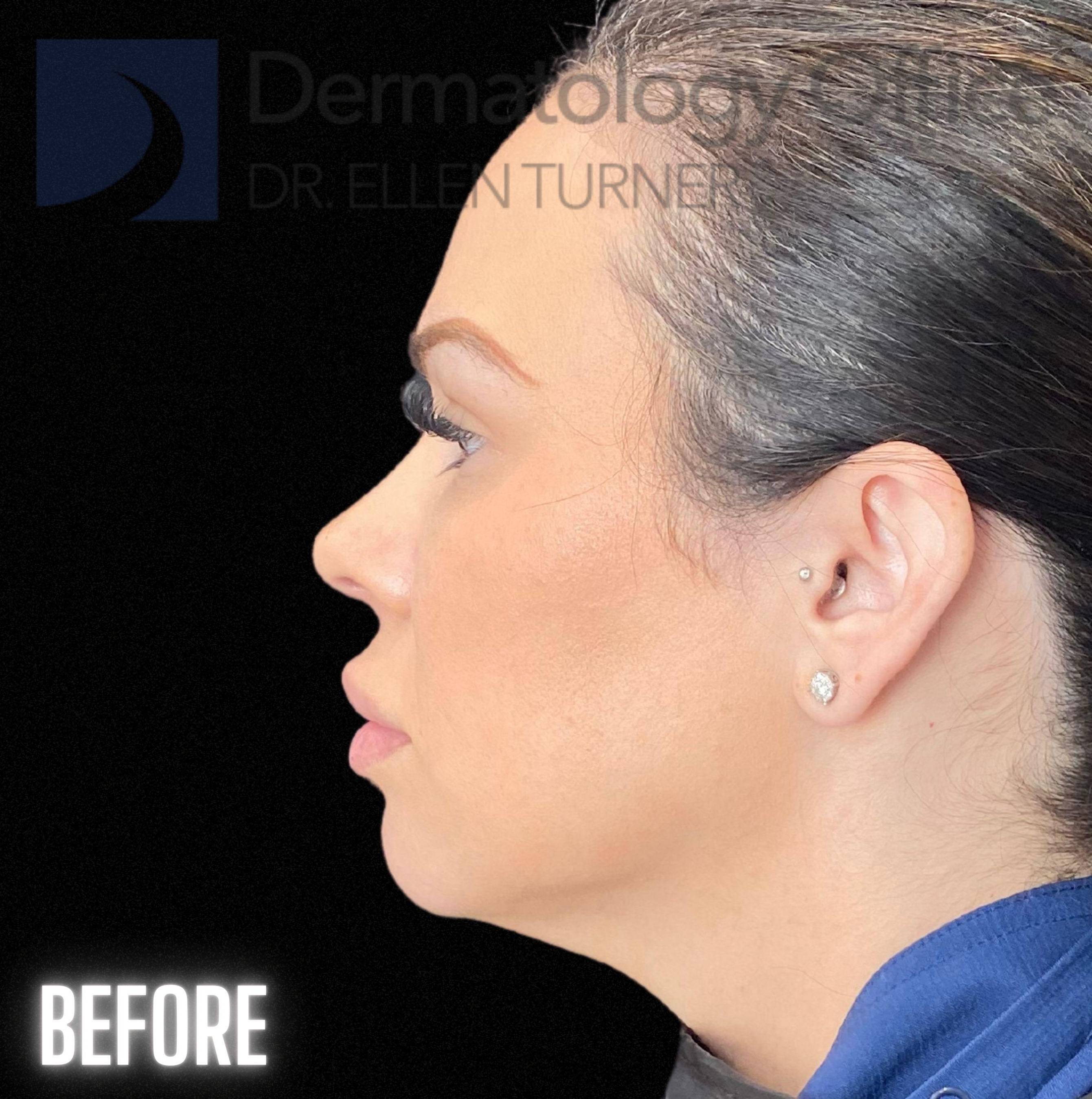 Volux (4 syringes) Before and After Case -2 Before