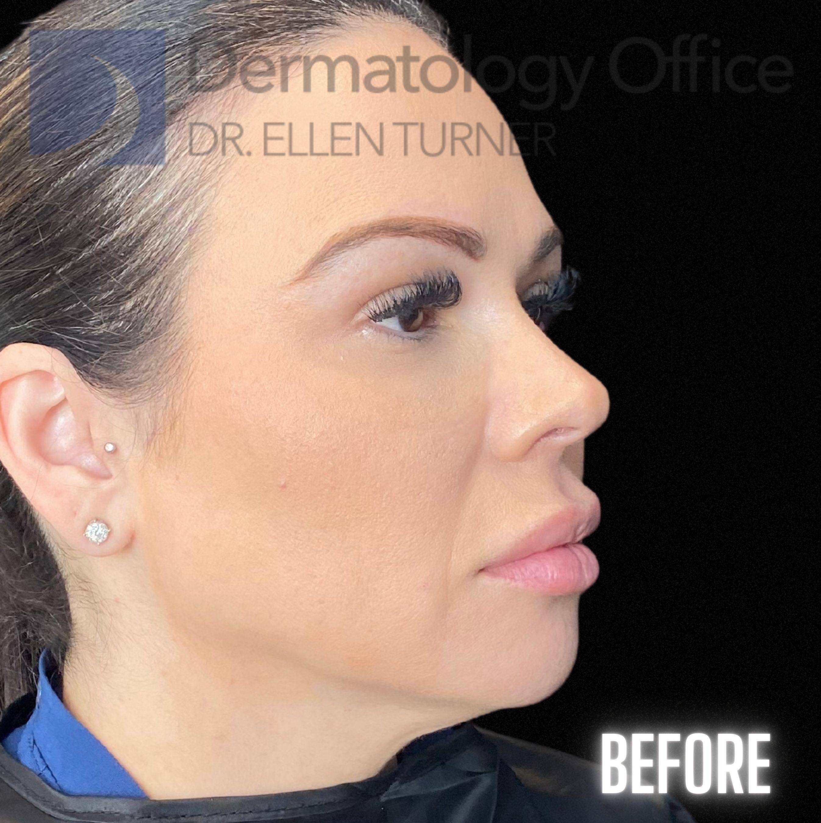 Volux (4 syringes) Before and After Case -3 Before