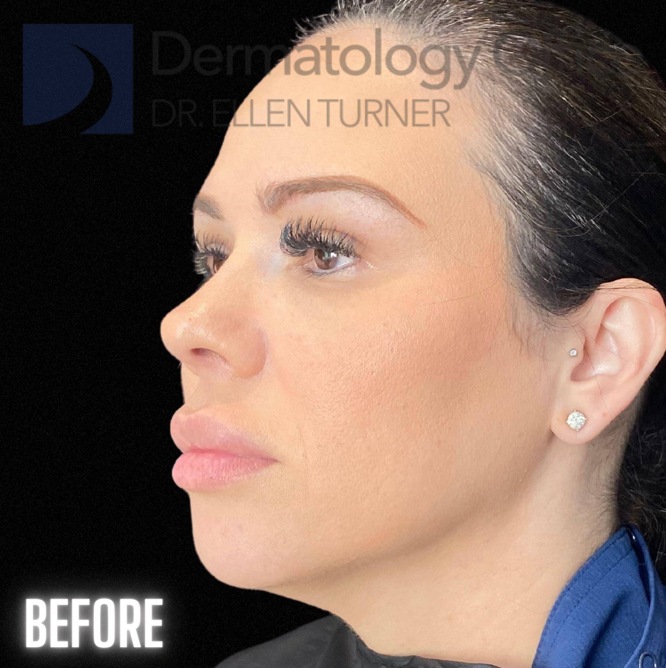 Volux (4 syringes) Before and After Case -4 Before