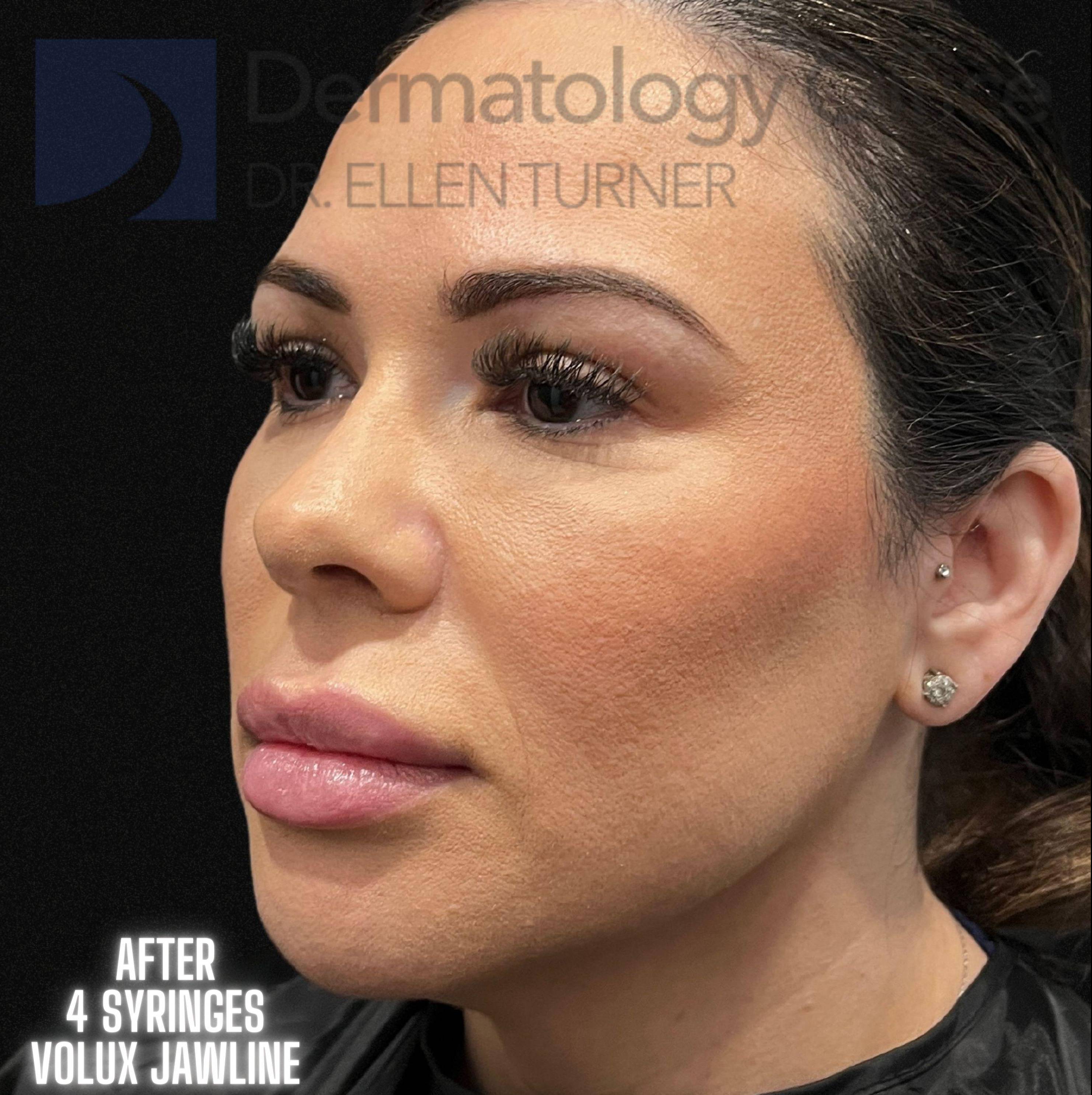 Volux (4 syringes) Before and After Case -4 After