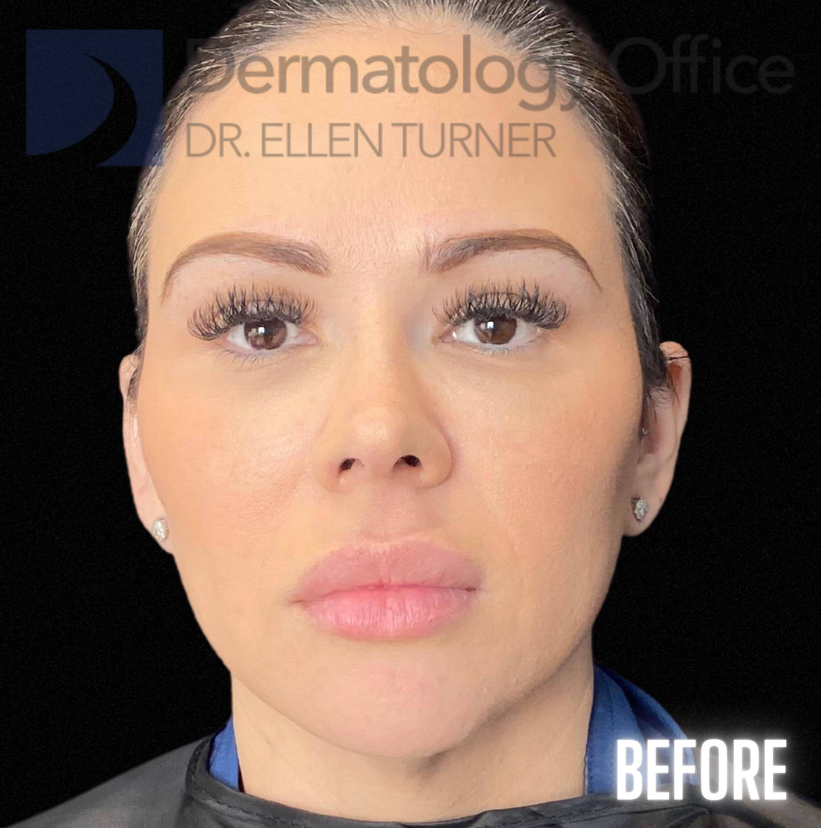 Volux (4 syringes) Before and After Case -5 Before