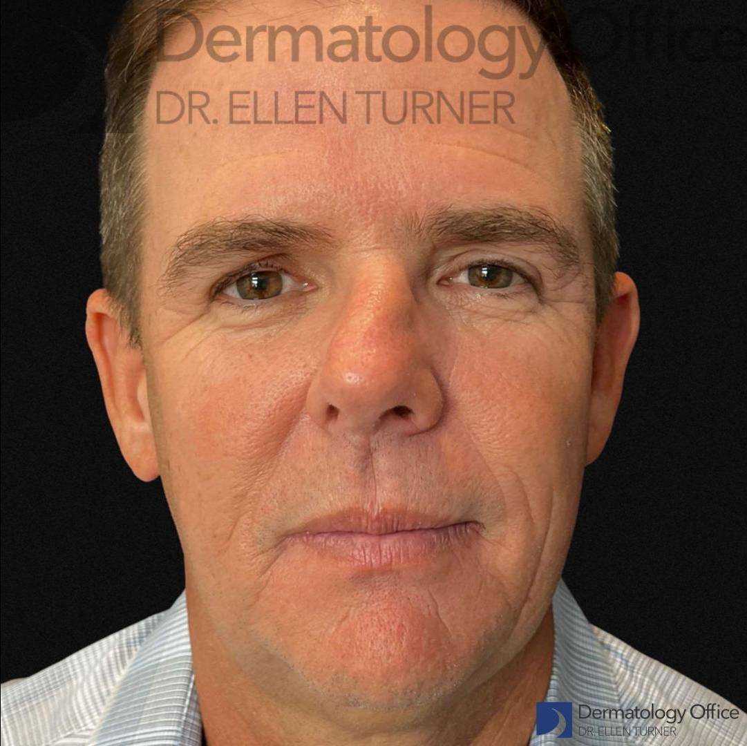 EMFACE (4 treatments) Before and After Case-30 Before