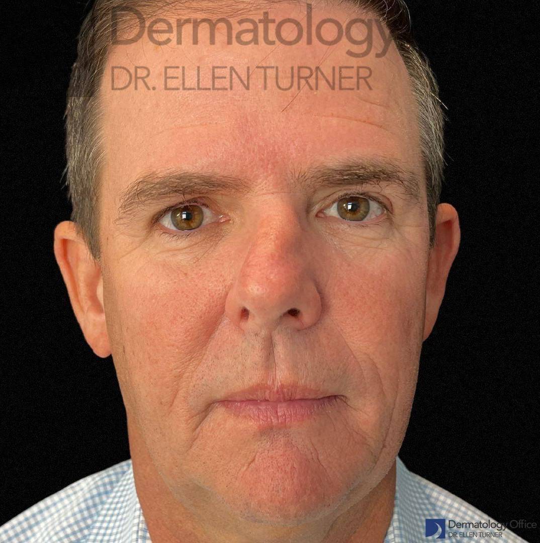 EMFACE (4 treatments) Before and After Case-30 After