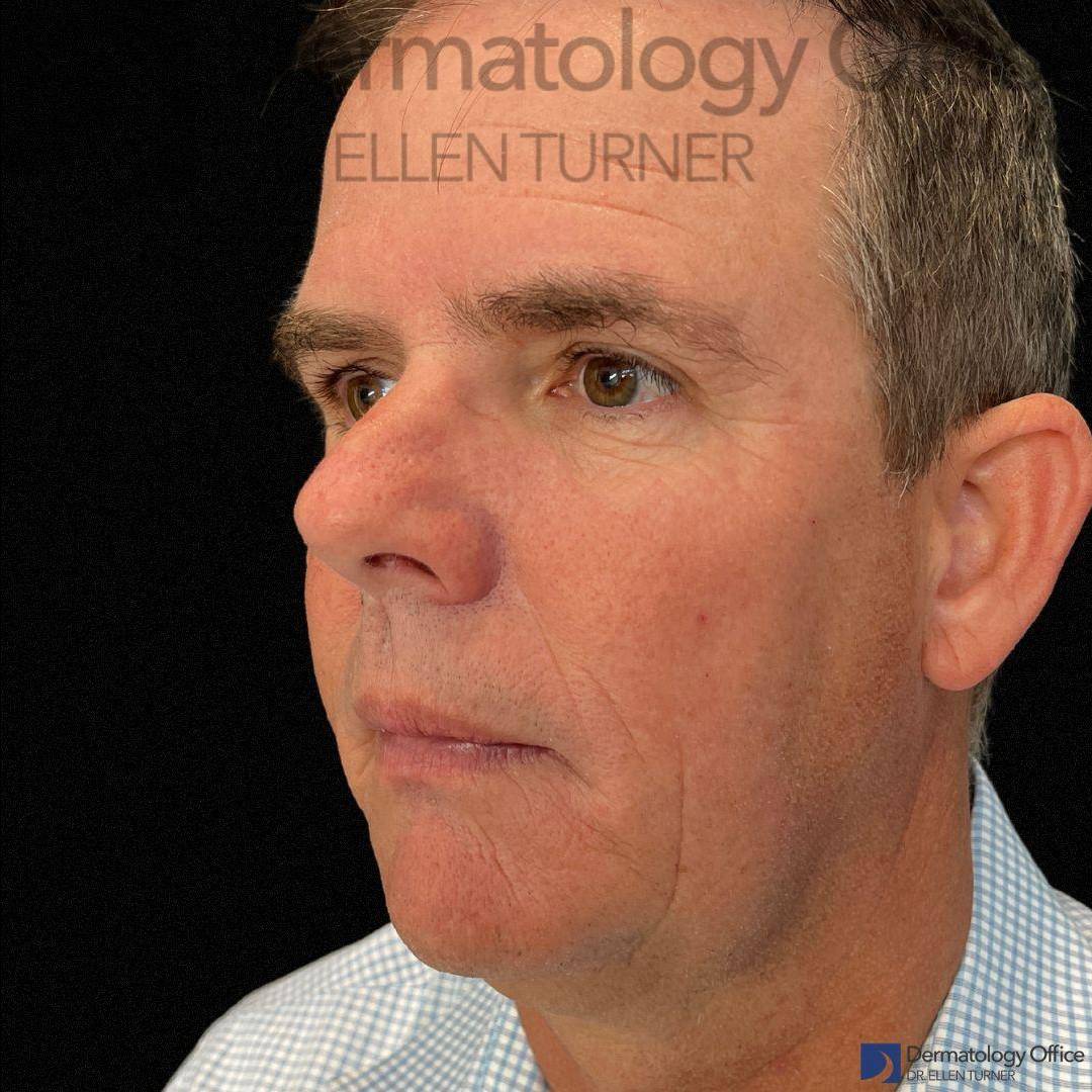 EMFACE (4 treatments) Before and After Case-31 After