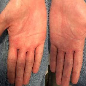 Allergic Contact Dermatitis Before and After Case 3 After