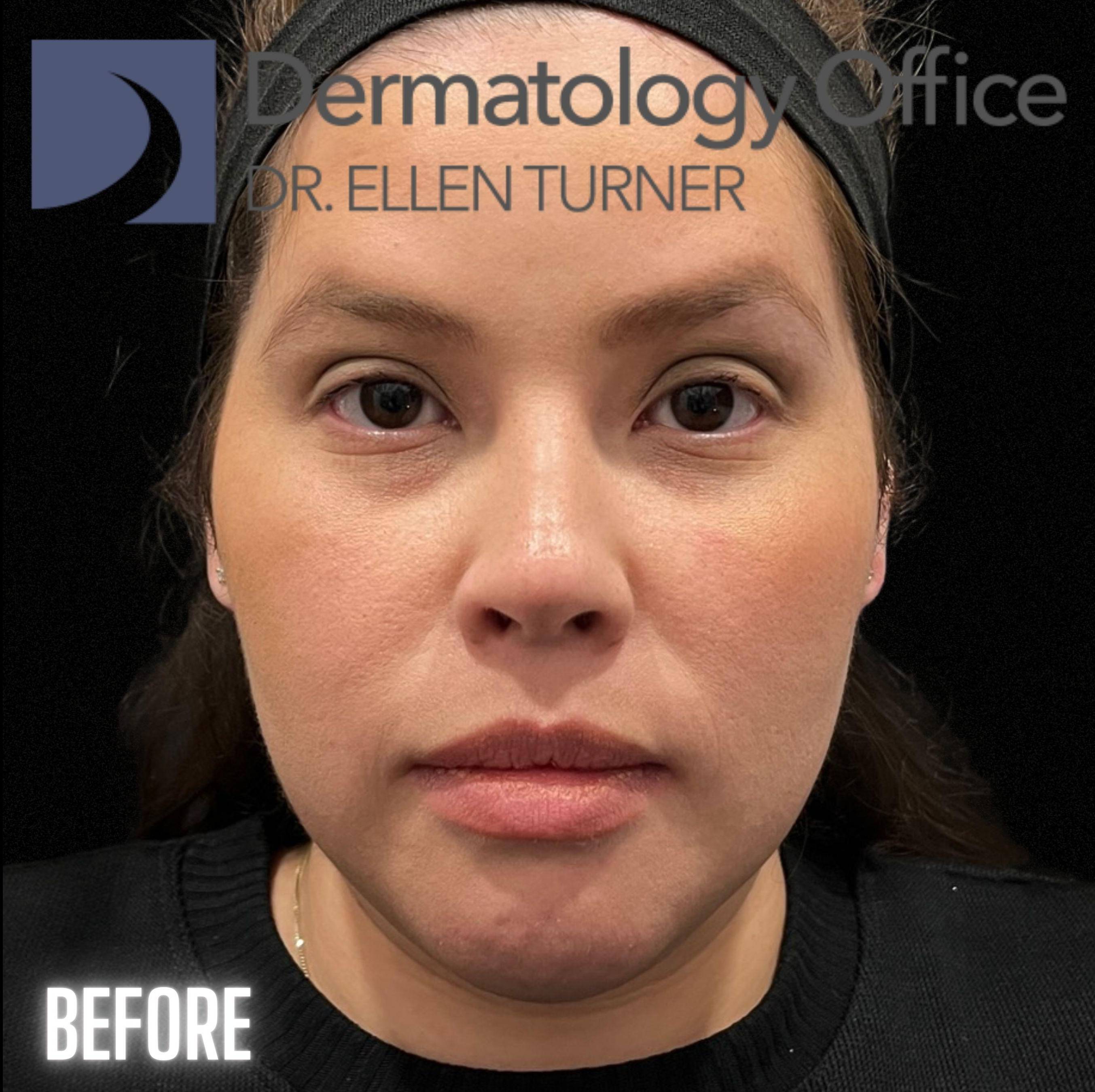 Volux (4 syringes) Before and After Case -8 Before