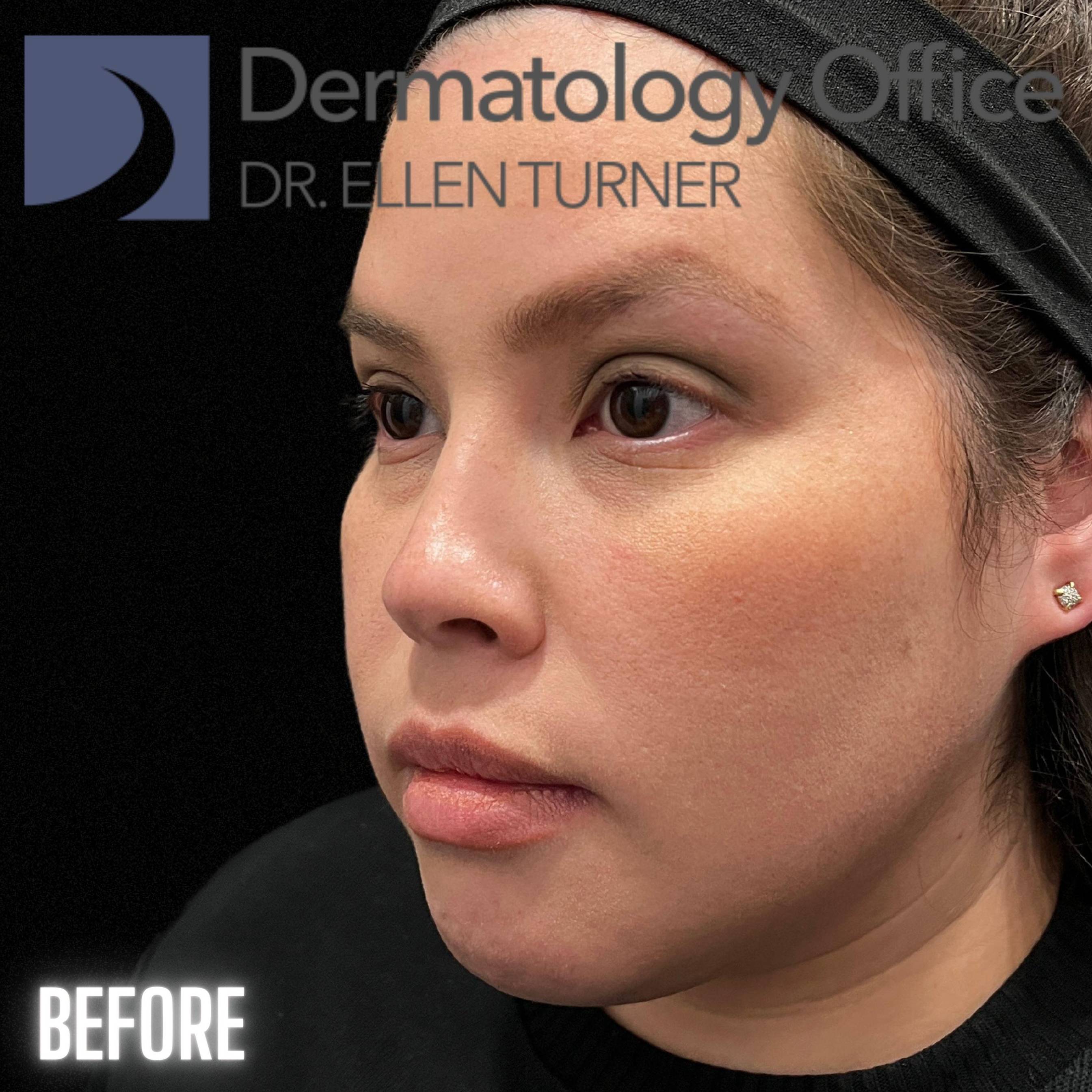 Volux (4 syringes) Before and After Case -9 Before