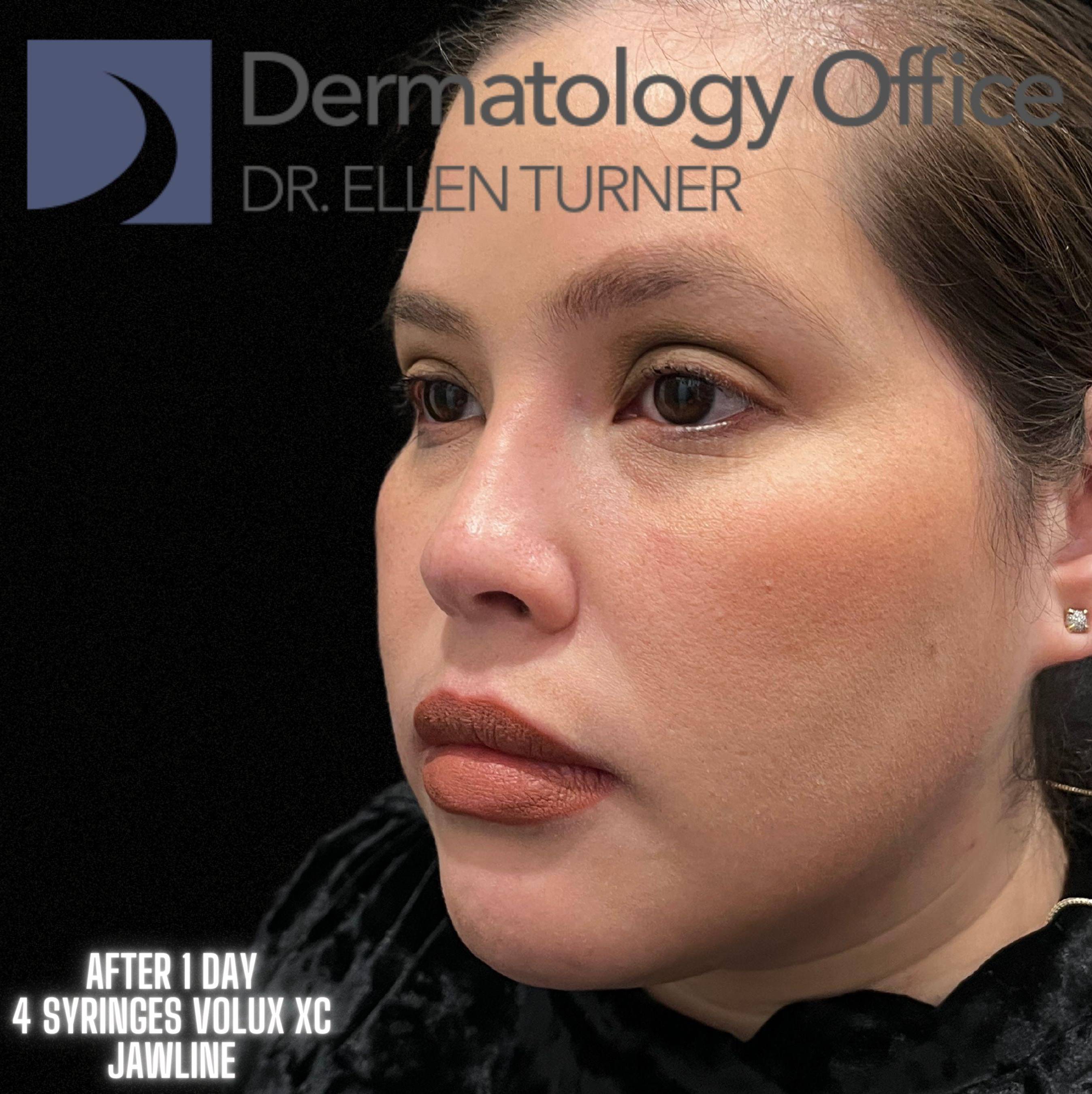 Volux (4 syringes) Before and After Case -9 After