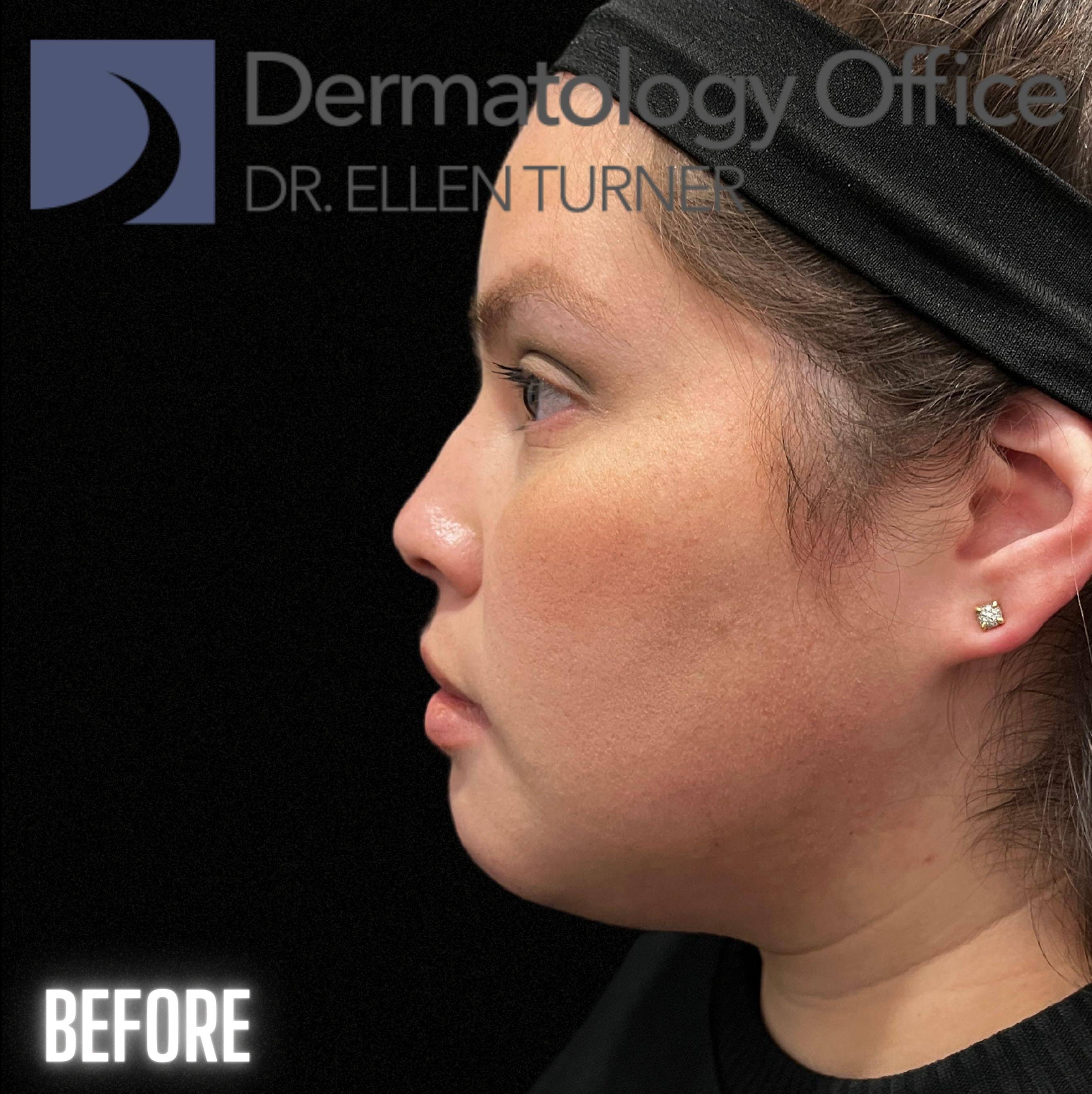 Volux (4 syringes) Before and After Case -10 Before