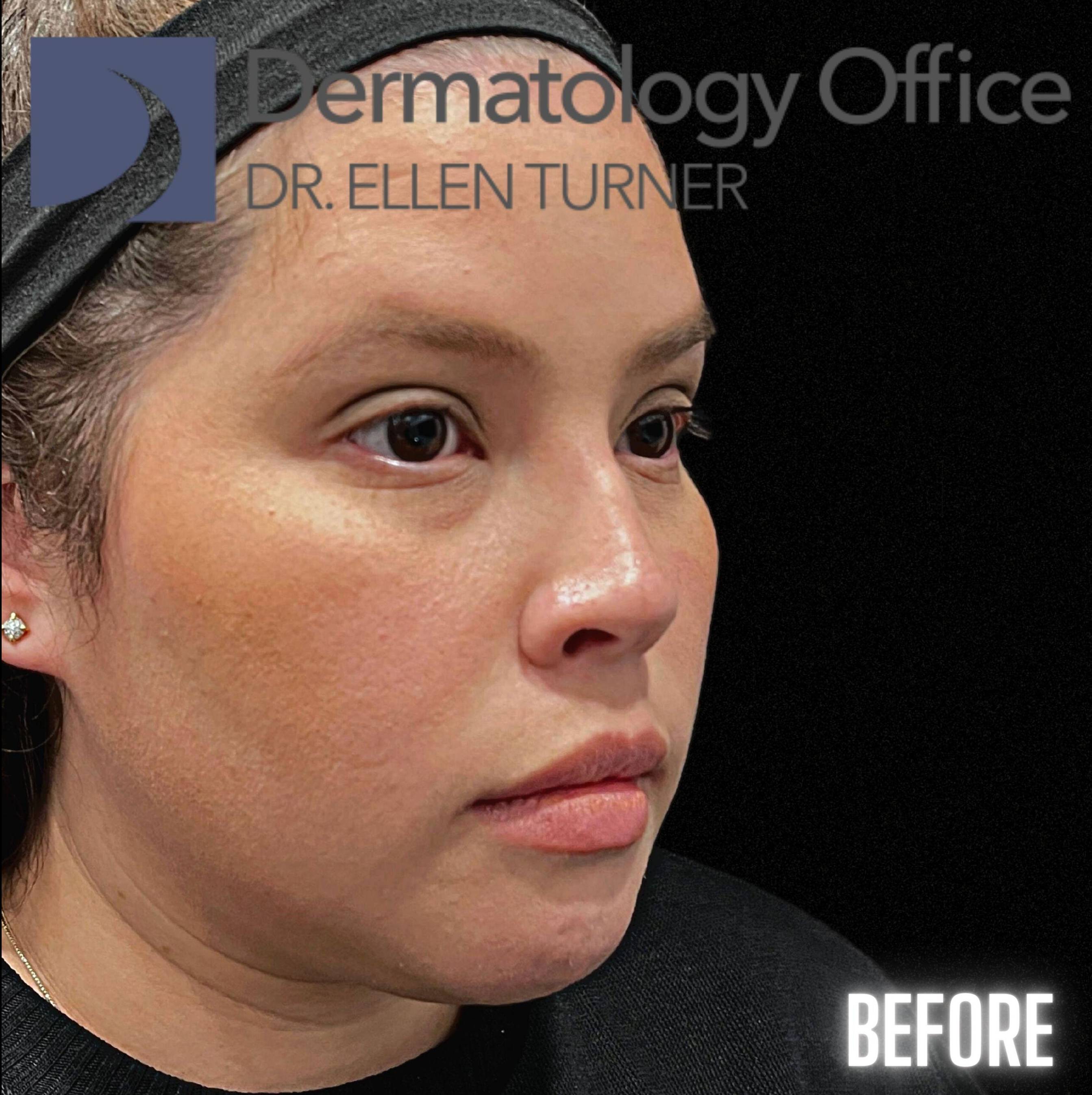 Volux (4 syringes) Before and After Case -11 Before