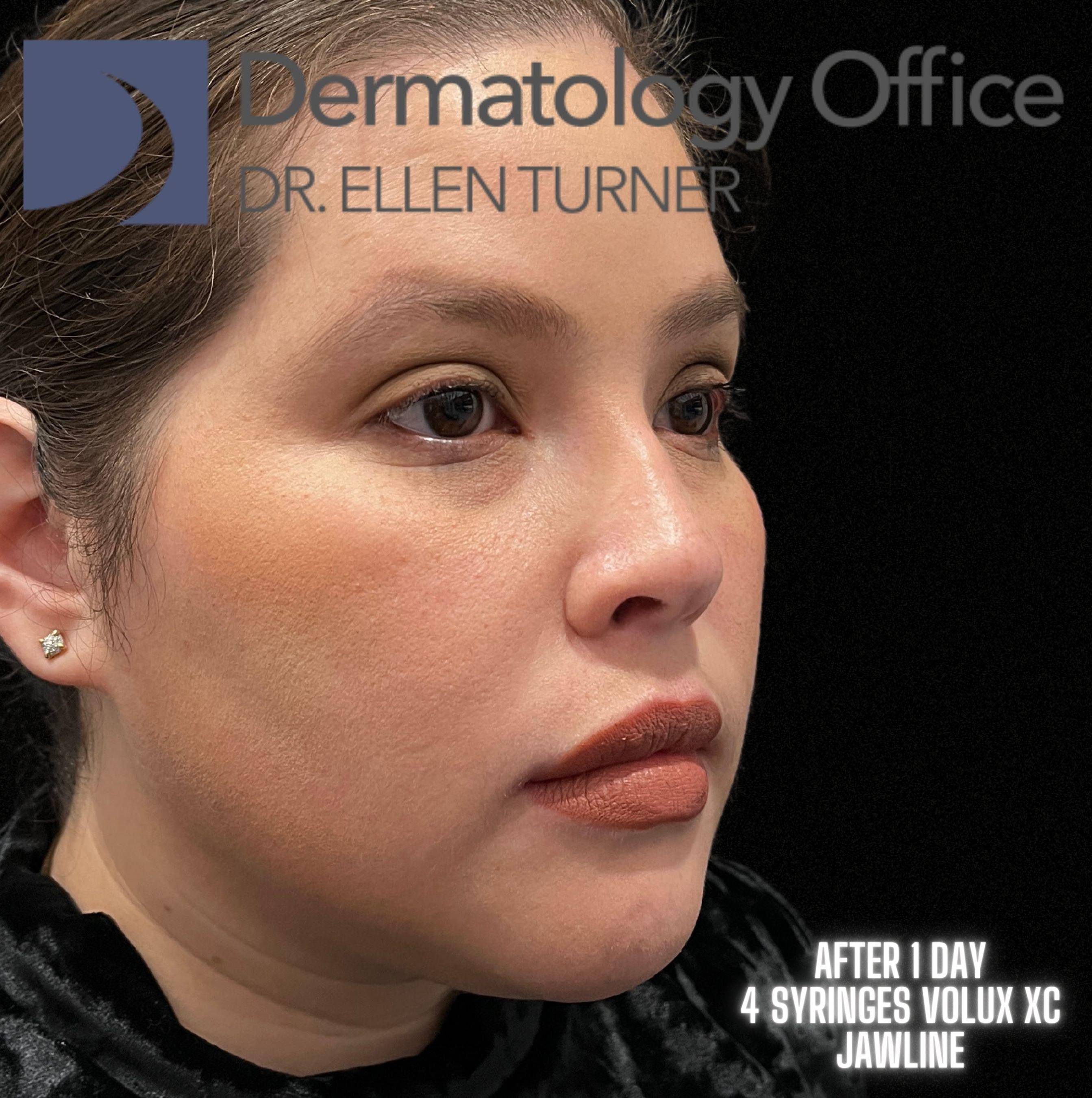 Volux (4 syringes) Before and After Case -11 After