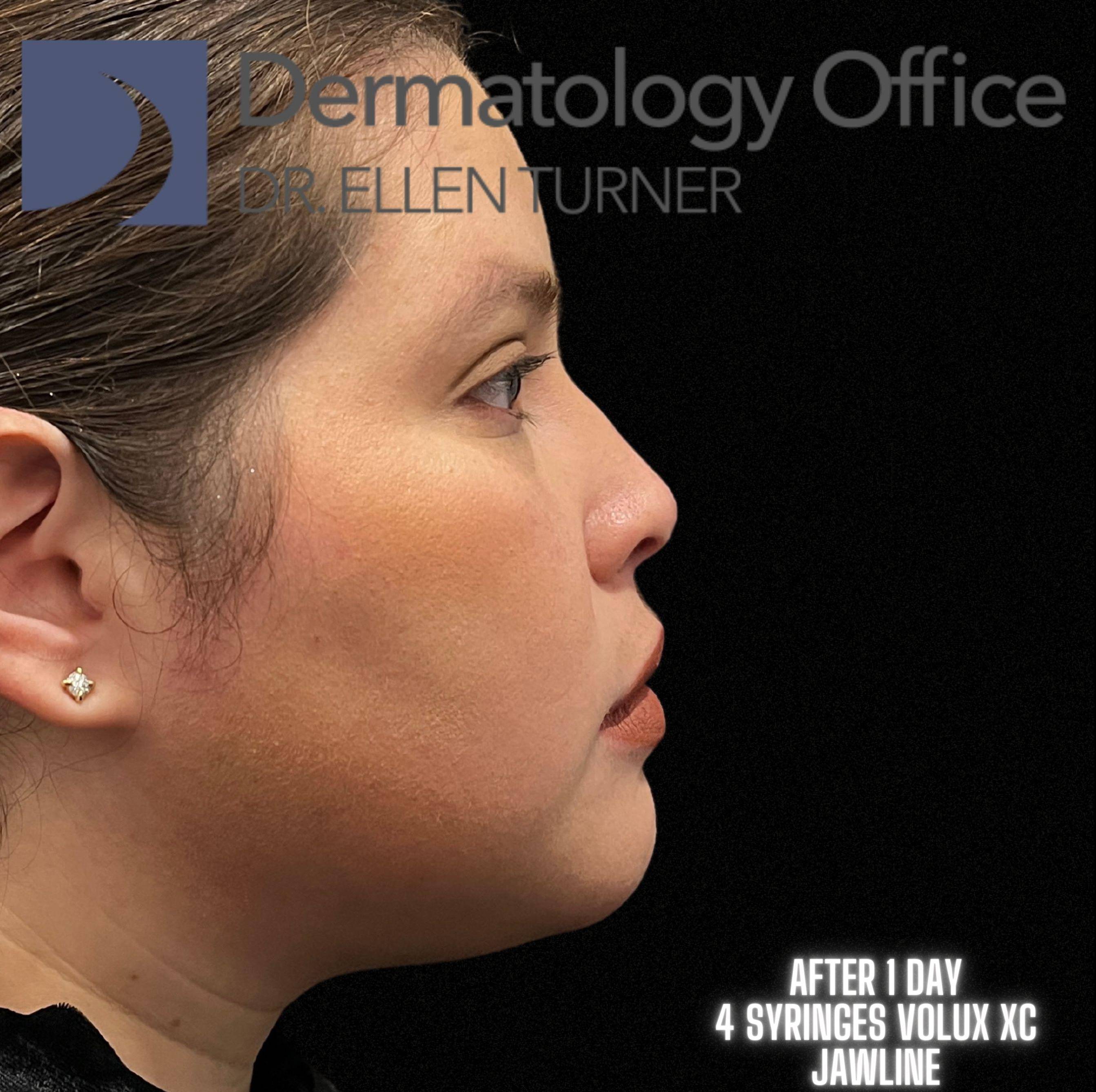 Volux (4 syringes) Before and After Case -12 After
