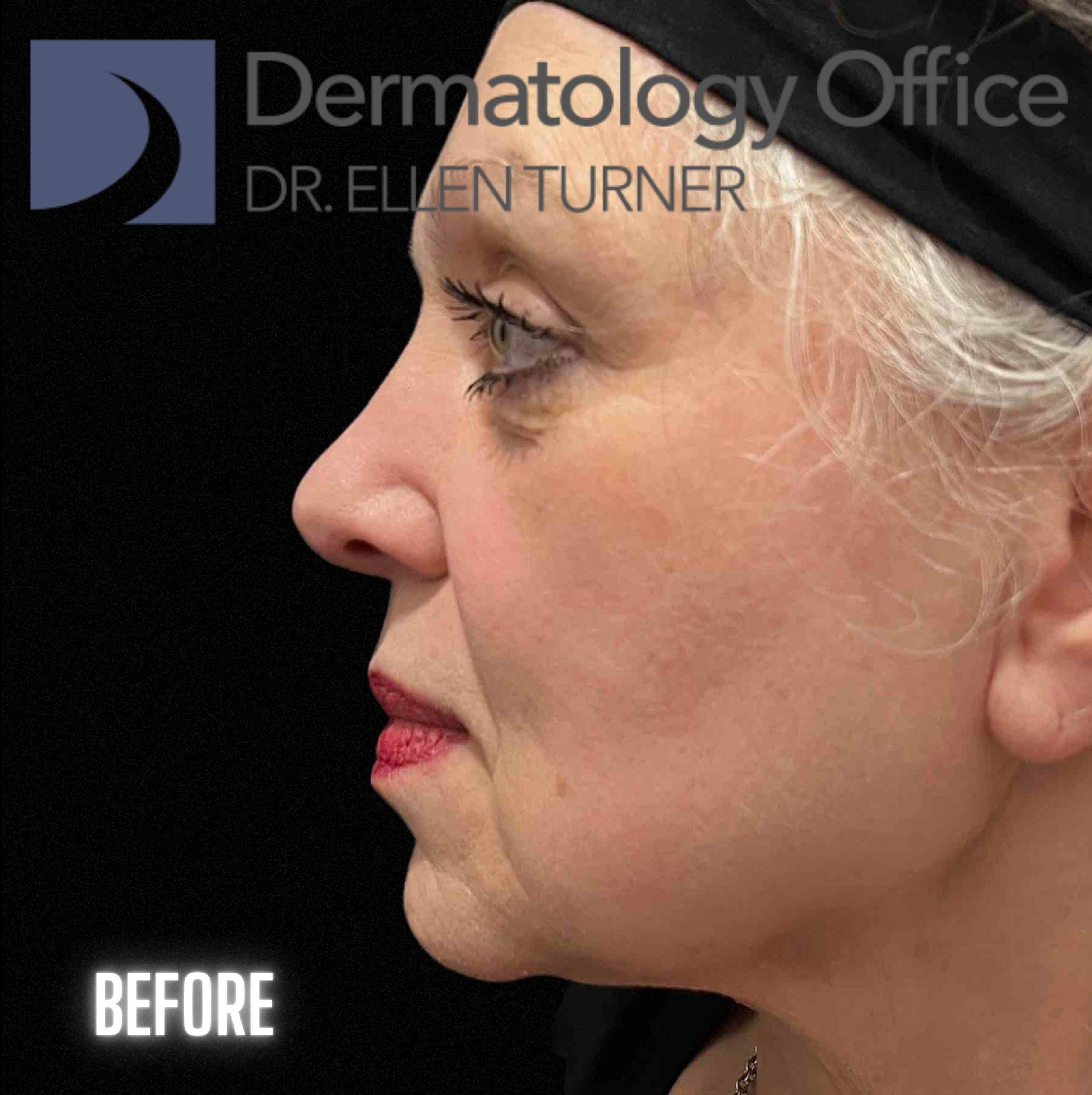 Volux (4 syringes) Before and After Case -6 Before