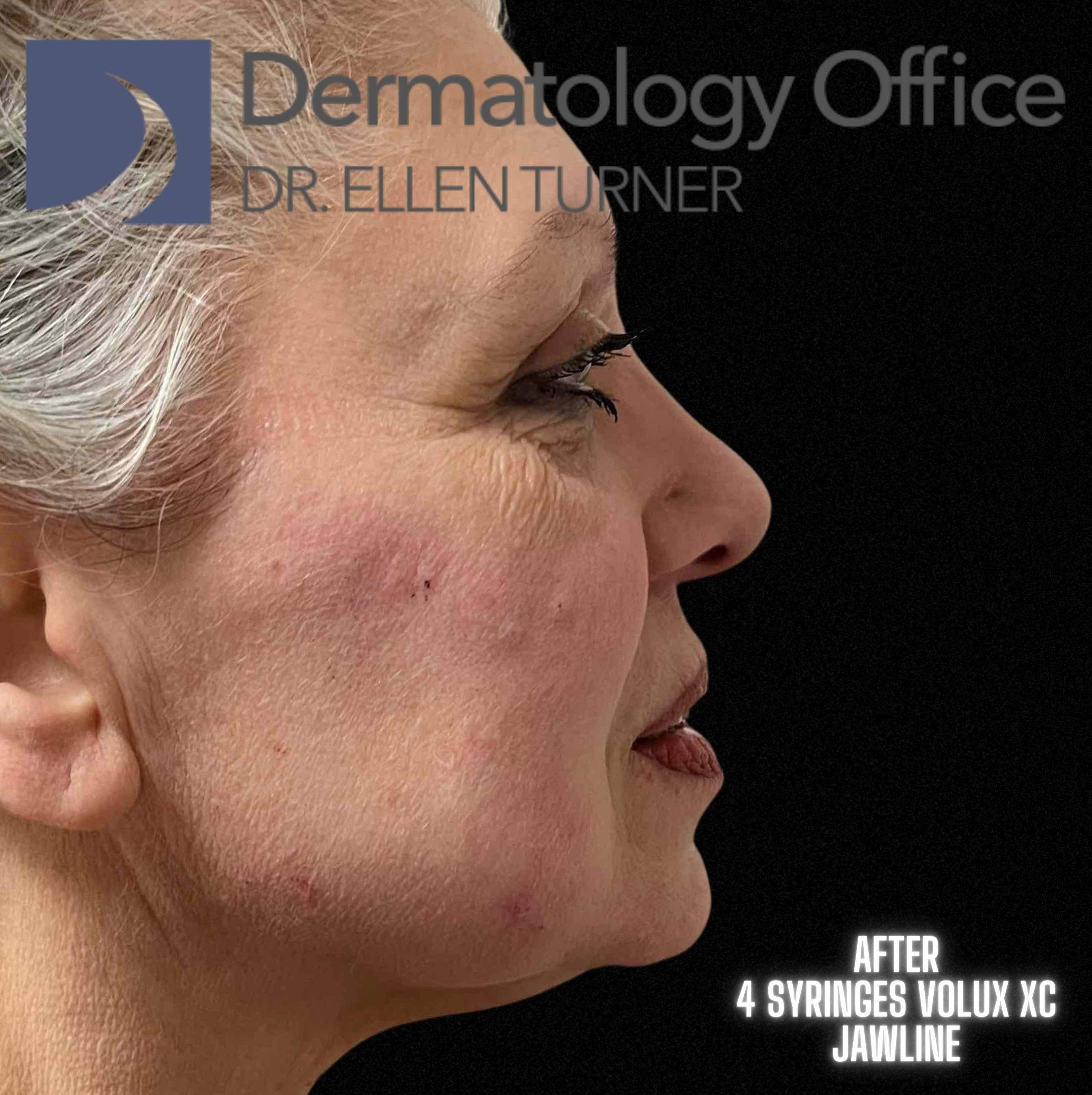 Volux (4 syringes) Before and After Case -7 After