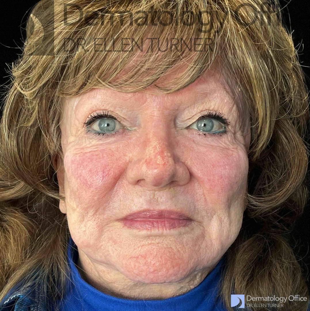 EMFACE (4 treatments) Before and After Case-35 Before