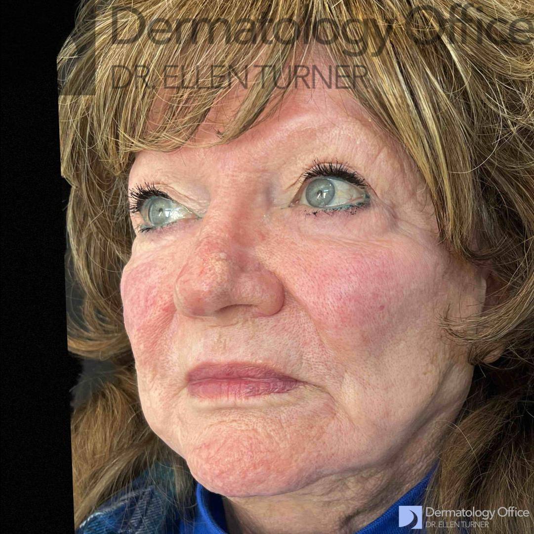 EMFACE (4 treatments) Before and After Case-36 Before