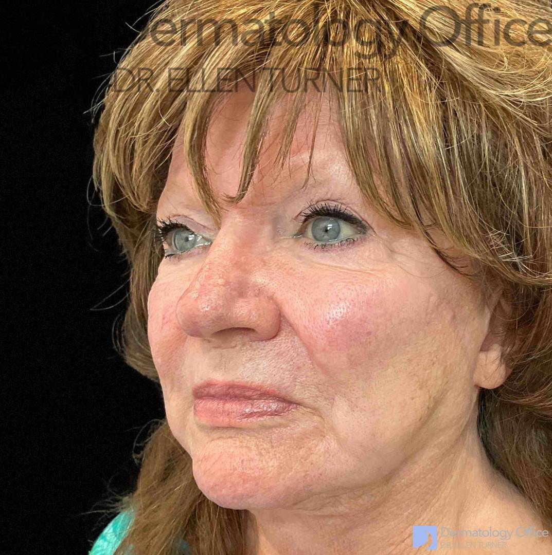EMFACE (4 treatments) Before and After Case-36 After